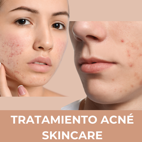 Tratamiento ANTIACNE