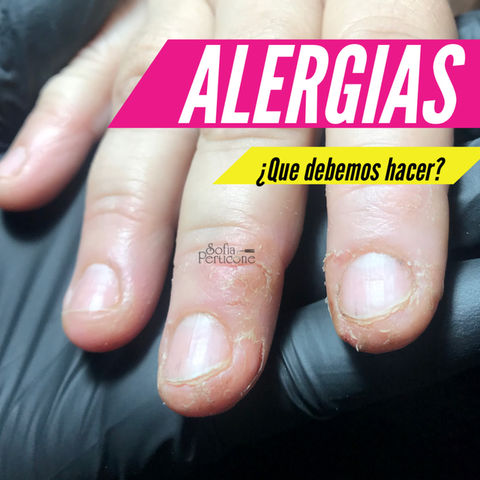 ALERGIAS, ¿Que hacer?