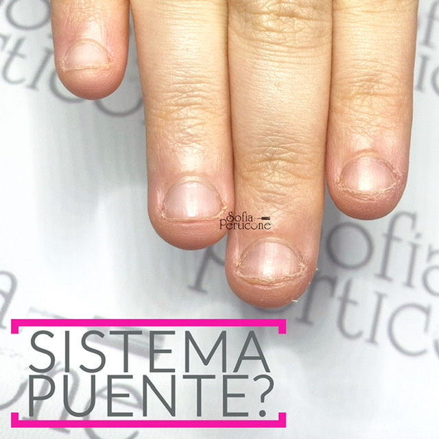 ONICOFAGIA: sistema puente ¿si o no? 