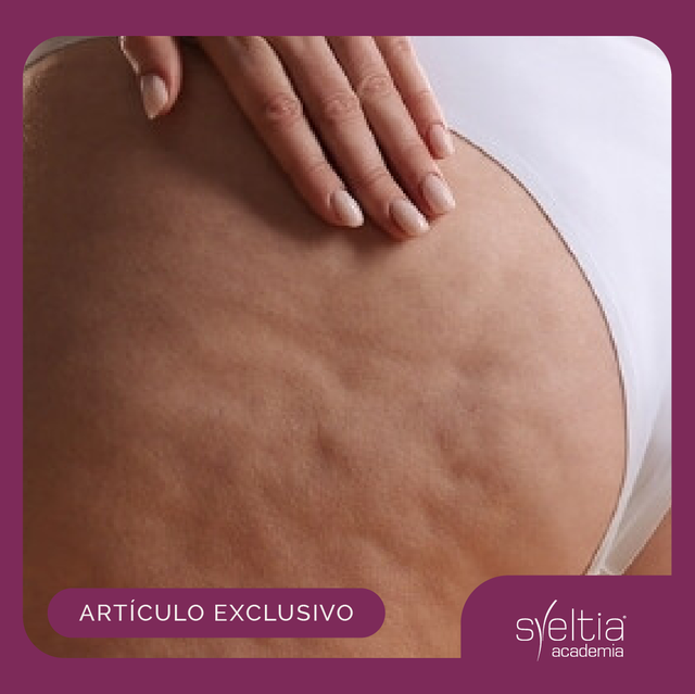 Celulitis: Opciones en tecnología
