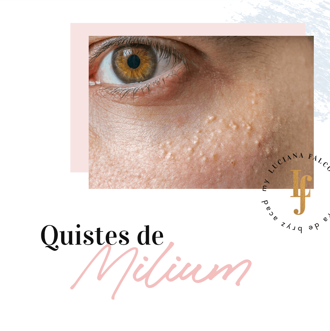 Quistes De Milium Bryz Academy