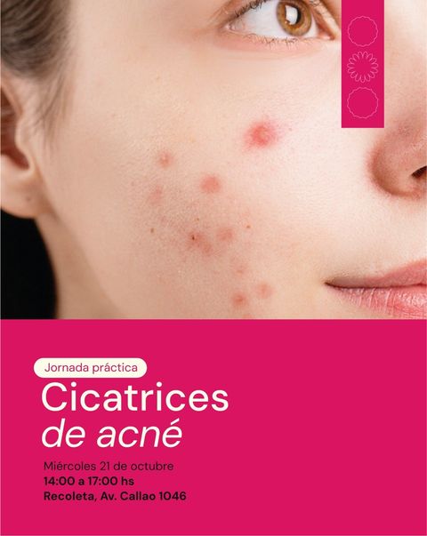 Jornada práctica: Cicatrices de Acné 