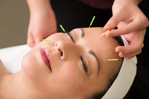 Microneedling y Acupuntura Cosmetica : Un Origen Común, Dos Caminos Distintos