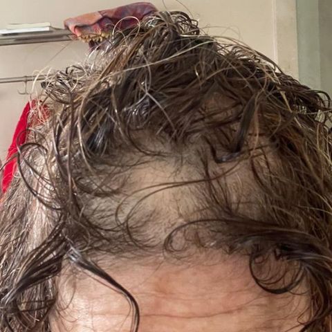 Alopecia Areata: Recuperación con un abordaje desde la raíz en Centro EVE