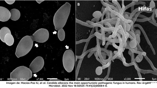 6 claves de la Candida en el intestino delgado (SIFO)