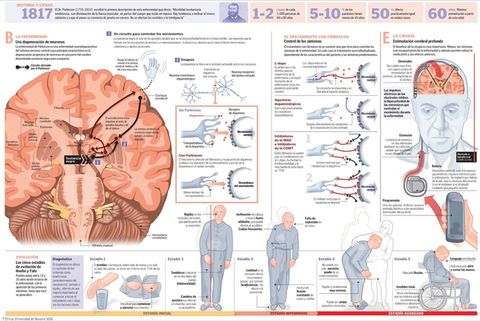 ¿El Parkinson comienza en el intestino?